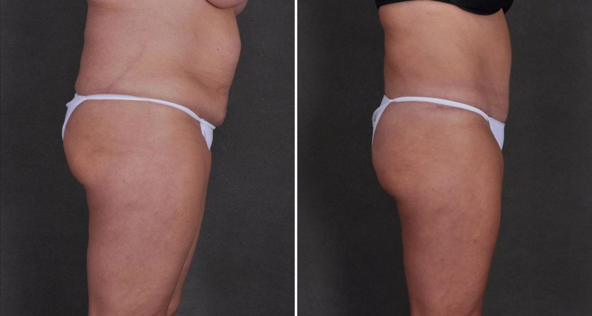 Liposuction Before and After Photos in Omaha, NE, Case 9824