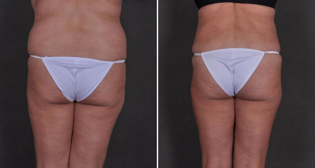 Liposuction Before and After Photos in Omaha, NE, Case 9824