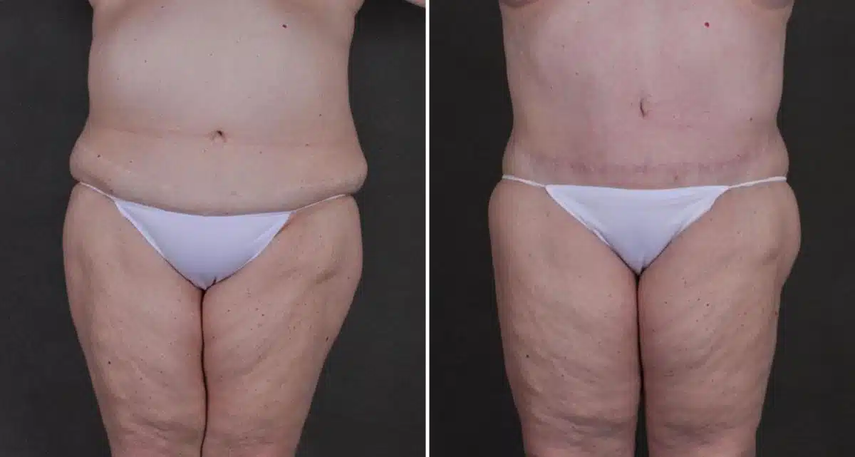 Liposuction Before and After Photos in Omaha, NE, Case 9834