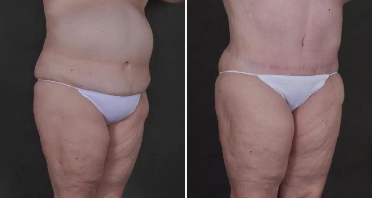 Liposuction Before and After Photos in Omaha, NE, Case 9834