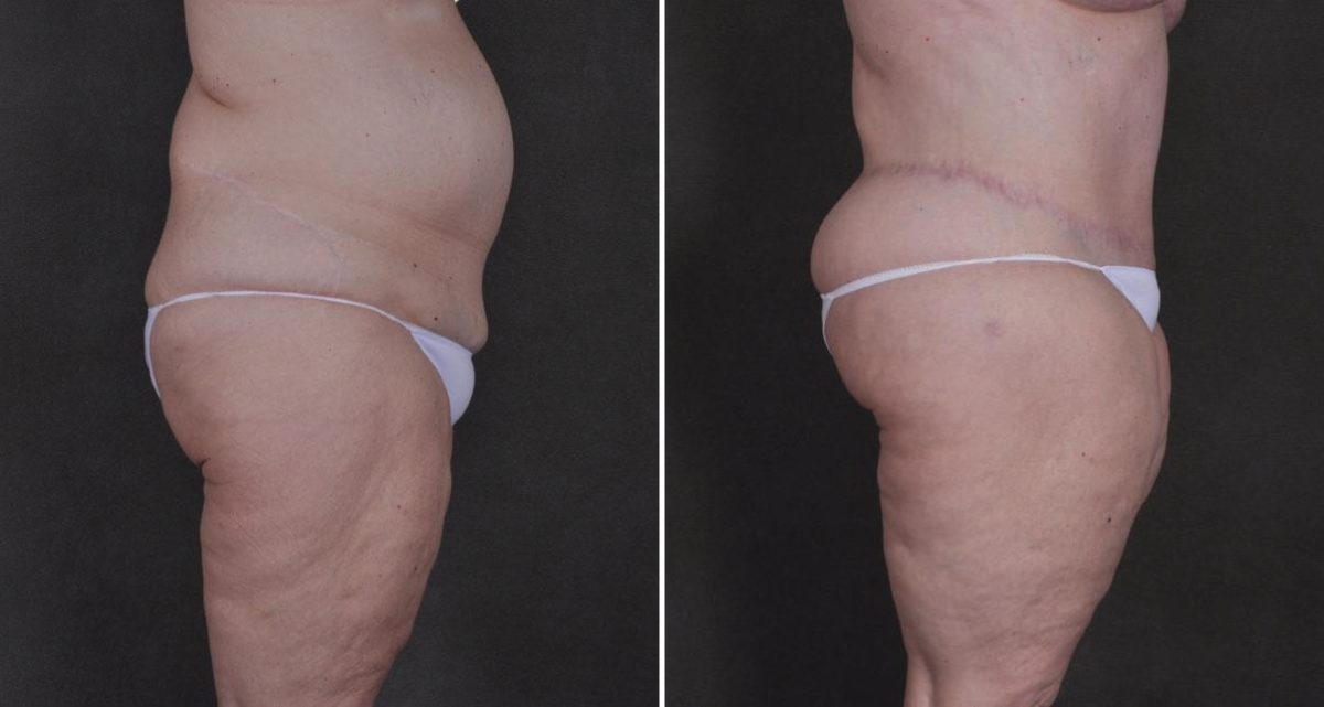 Liposuction Before and After Photos in Omaha, NE, Case 9834