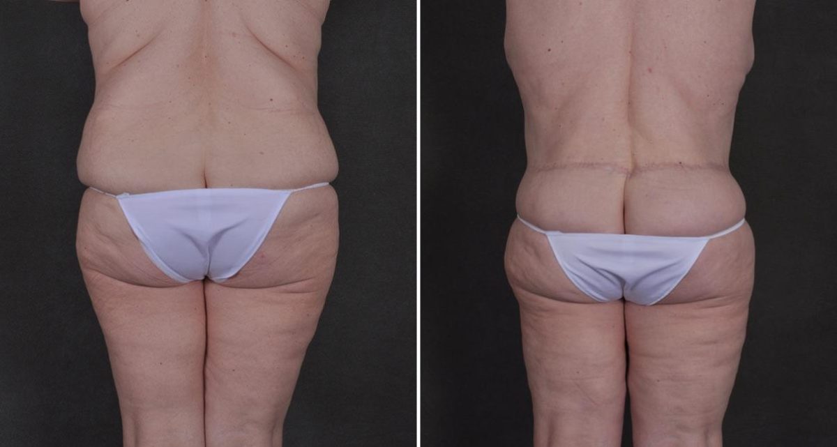 Liposuction Before and After Photos in Omaha, NE, Case 9834