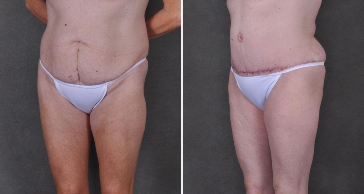 Liposuction Before and After Photos in Omaha, NE, Case 9192