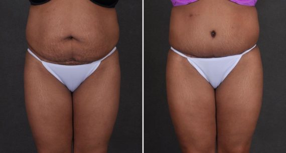 Liposuction Before and After Photos in Omaha, NE, Case 9868