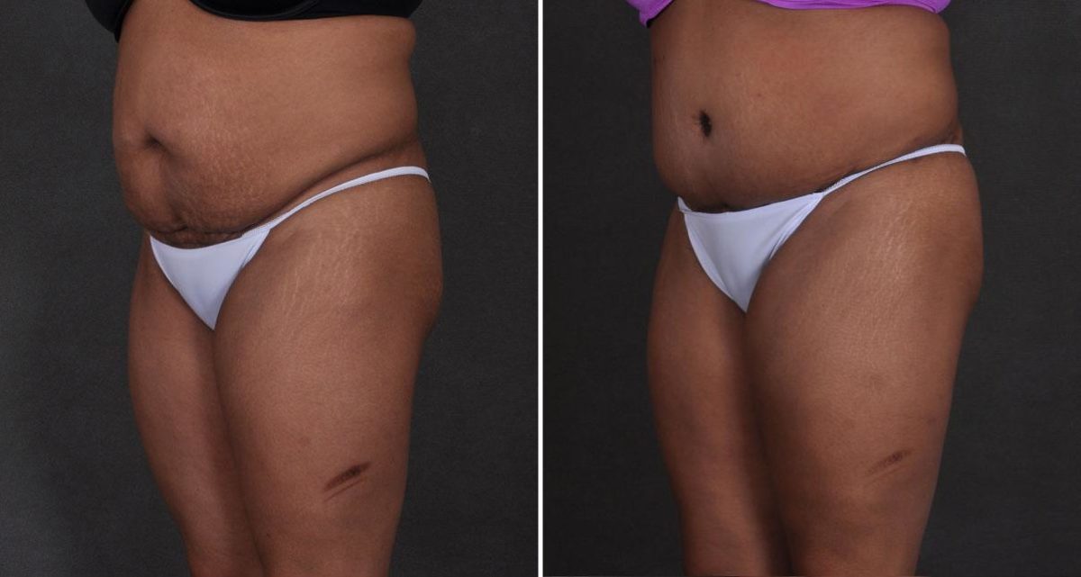 Liposuction Before and After Photos in Omaha, NE, Case 9868