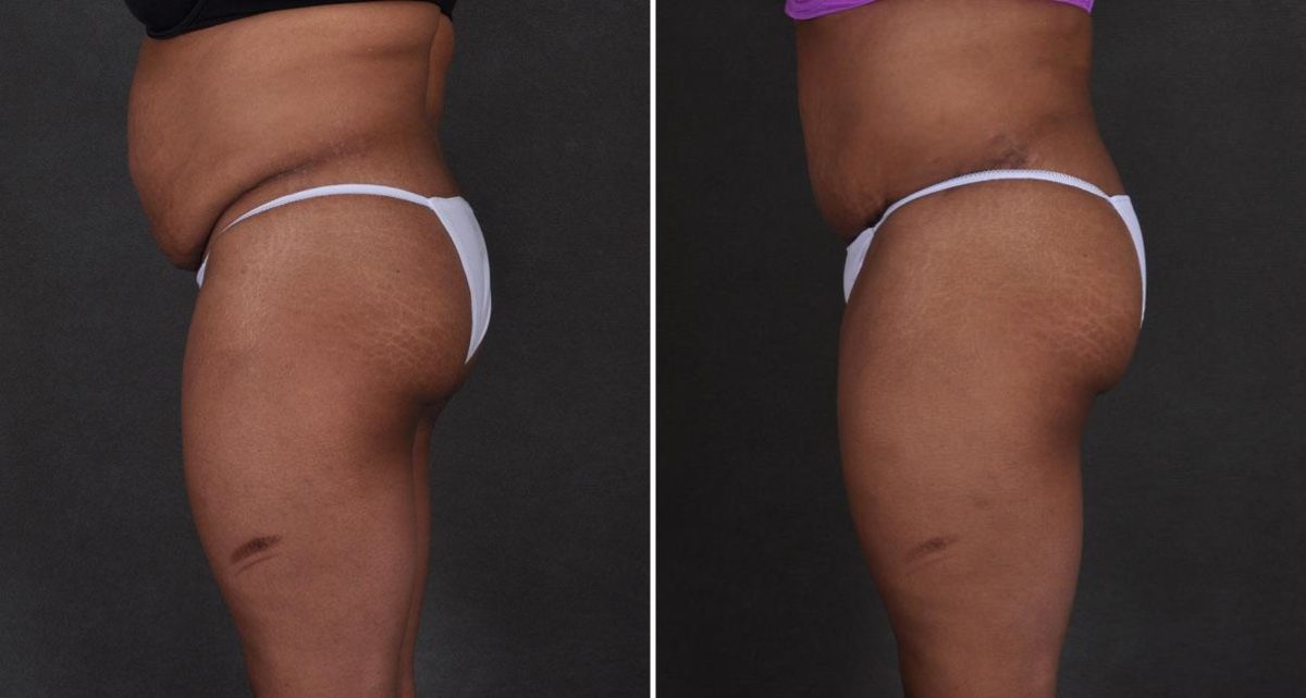 Liposuction Before and After Photos in Omaha, NE, Case 9868