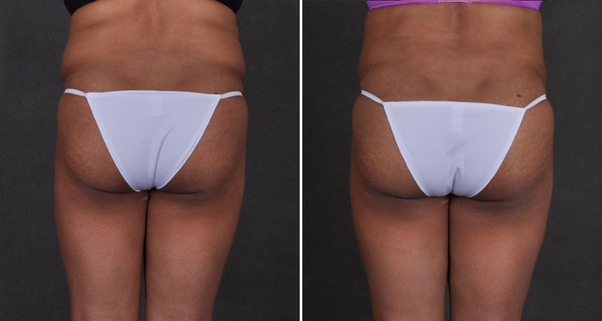 Liposuction Before and After Photos in Omaha, NE, Case 9868