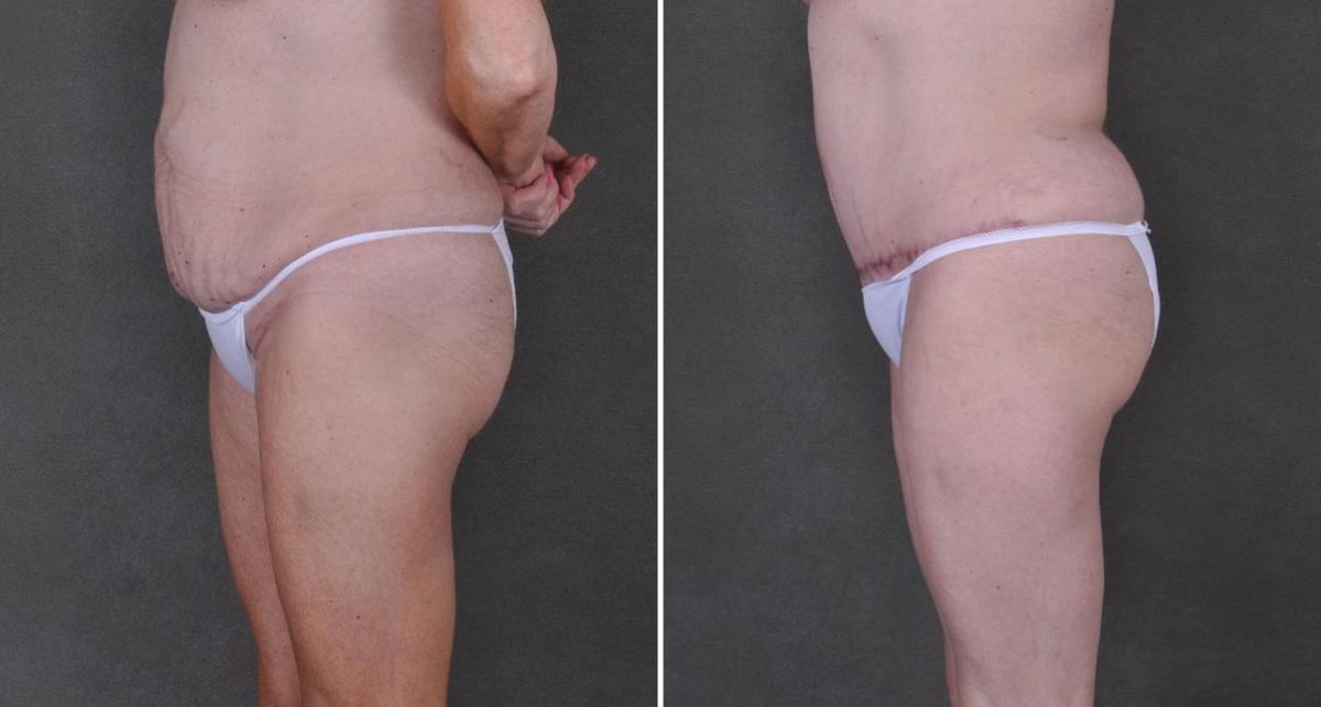 Liposuction Before and After Photos in Omaha, NE, Case 9192