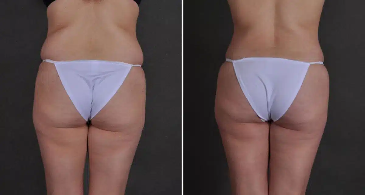 Brazilian Butt Lift Before and After Photos in Omaha, NE, Case 9774