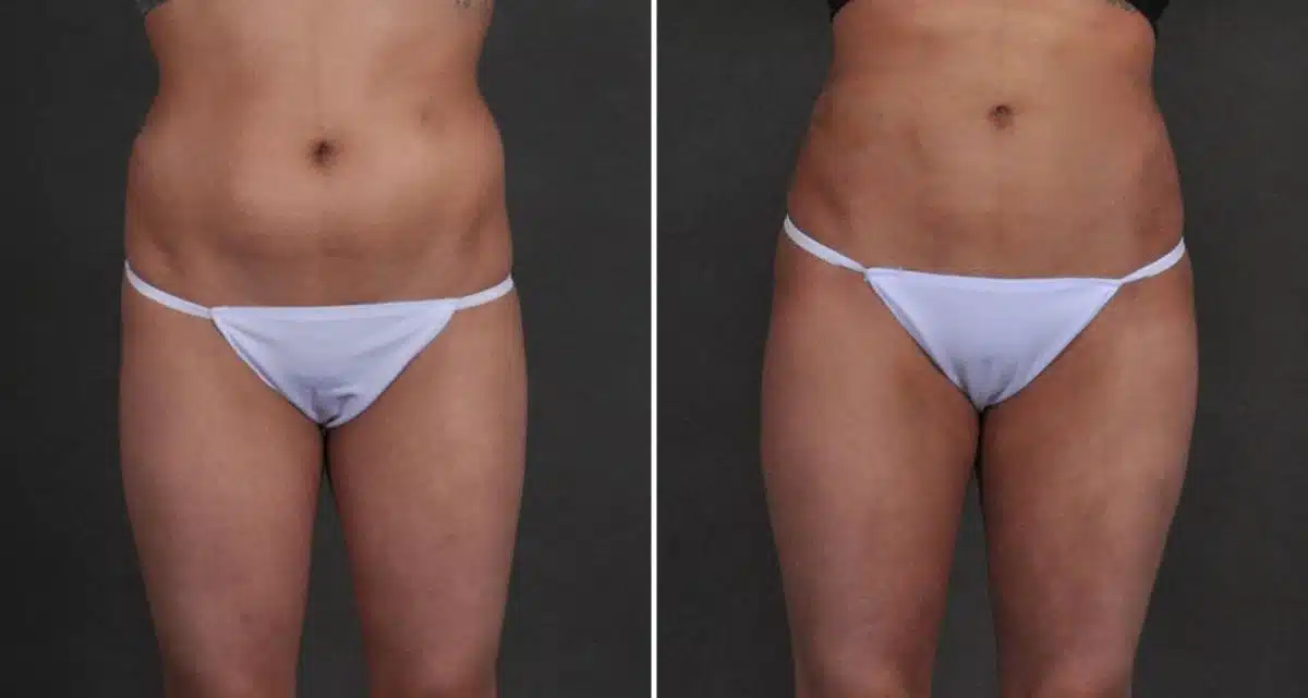 Brazilian Butt Lift Before and After Photos in Omaha, NE, Case 9946