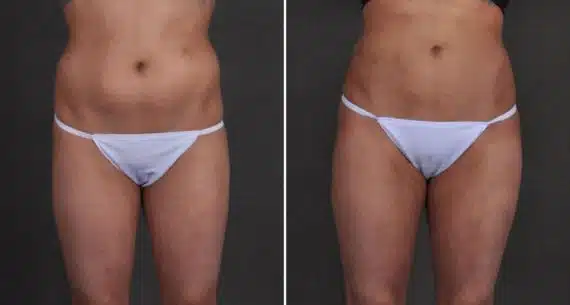 Brazilian Butt Lift Before and After Photos in Omaha, NE, Case 9946