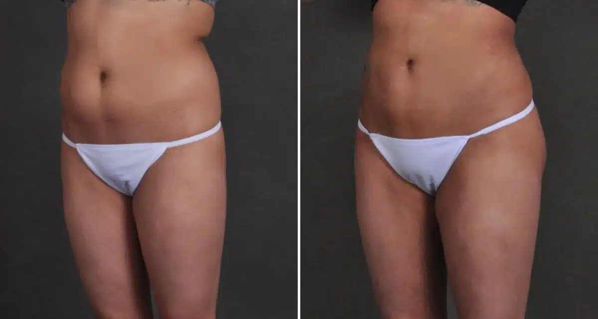 Brazilian Butt Lift Before and After Photos in Omaha, NE, Case 9946