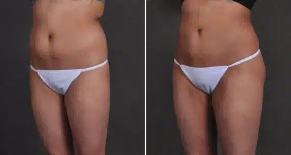 Brazilian Butt Lift Before and After Photos in Omaha, NE, Case 9946