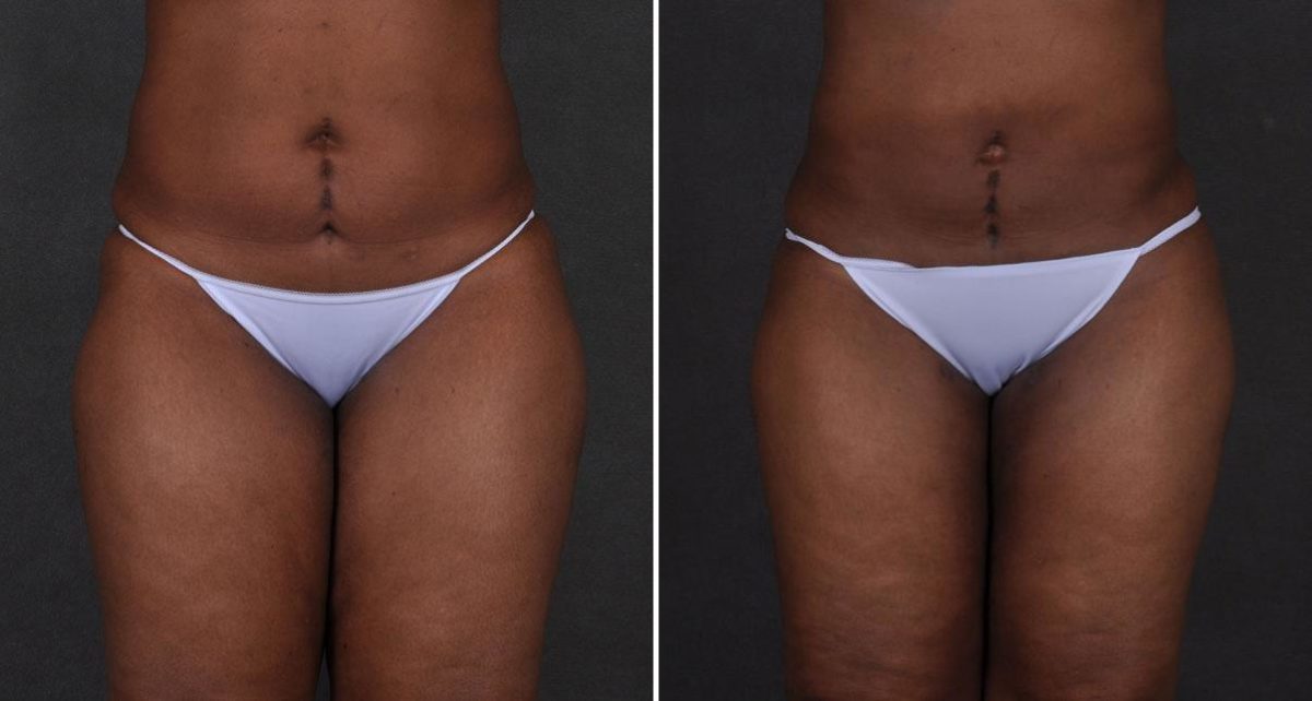 Case 9194, Brazilian Butt Lift Before and After Photos Brazilian Butt Lift Before and After Photos in Omaha, NE, Case 9194