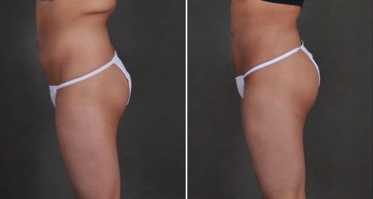 Brazilian Butt Lift Before and After Photos in Omaha, NE, Case 9946