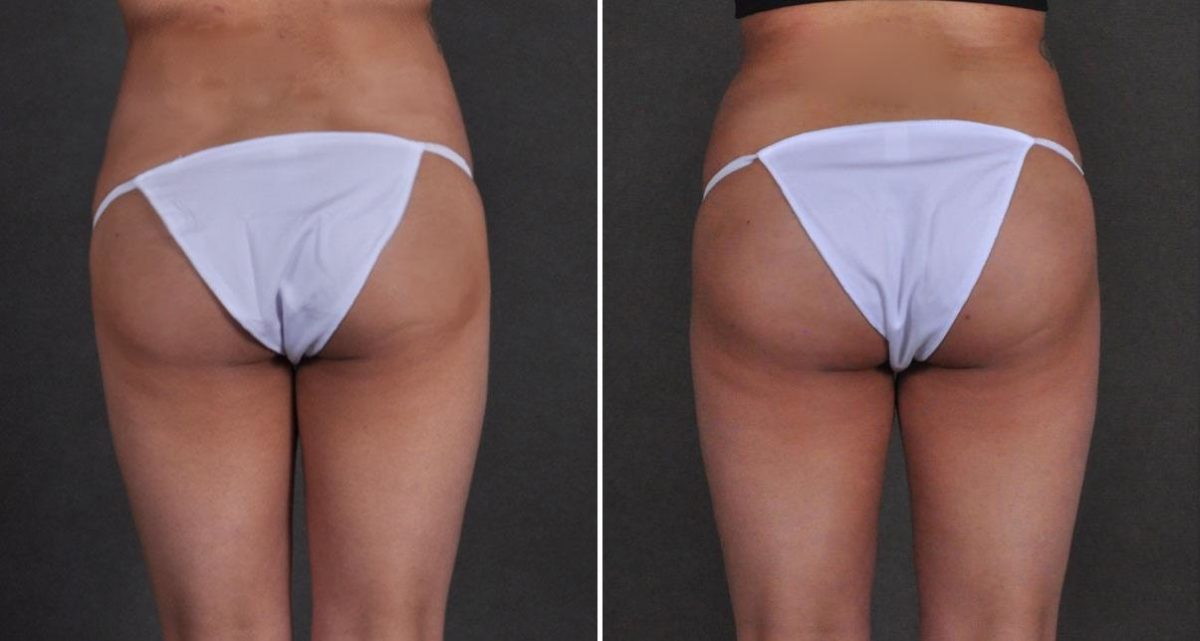 Brazilian Butt Lift Before and After Photos in Omaha, NE, Case 9946