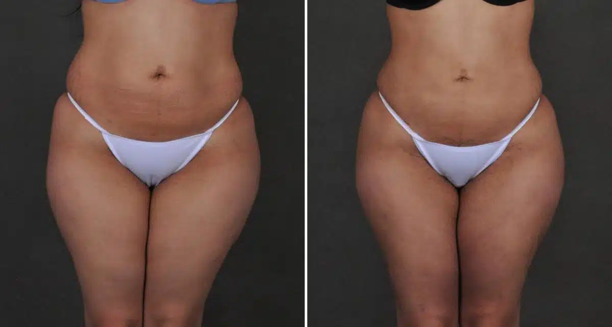 Brazilian Butt Lift Before and After Photos in Omaha, NE, Case 10228