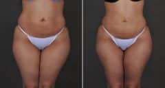 Brazilian Butt Lift Before and After Photos in Omaha, NE, Case 10228