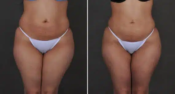 Should you get your BBL in Omaha or Miami? Omaha Liposuction