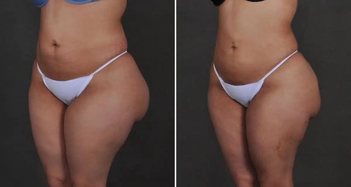 Brazilian Butt Lift Before and After Photos in Omaha, NE, Case 10228