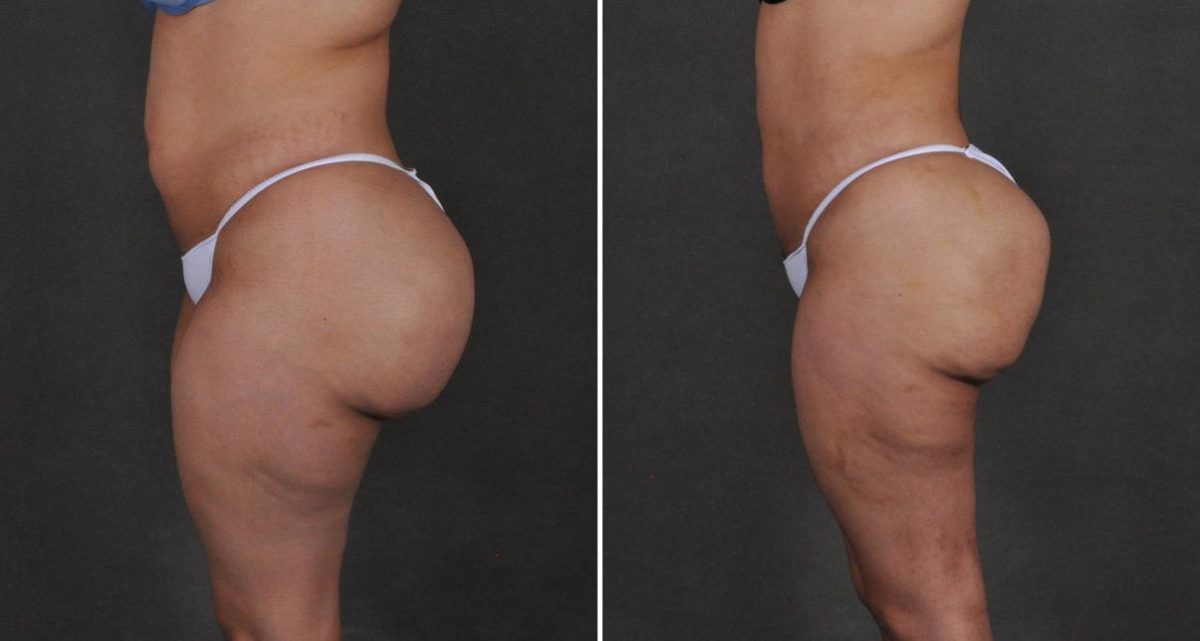 Brazilian Butt Lift Before and After Photos in Omaha, NE, Case 10228