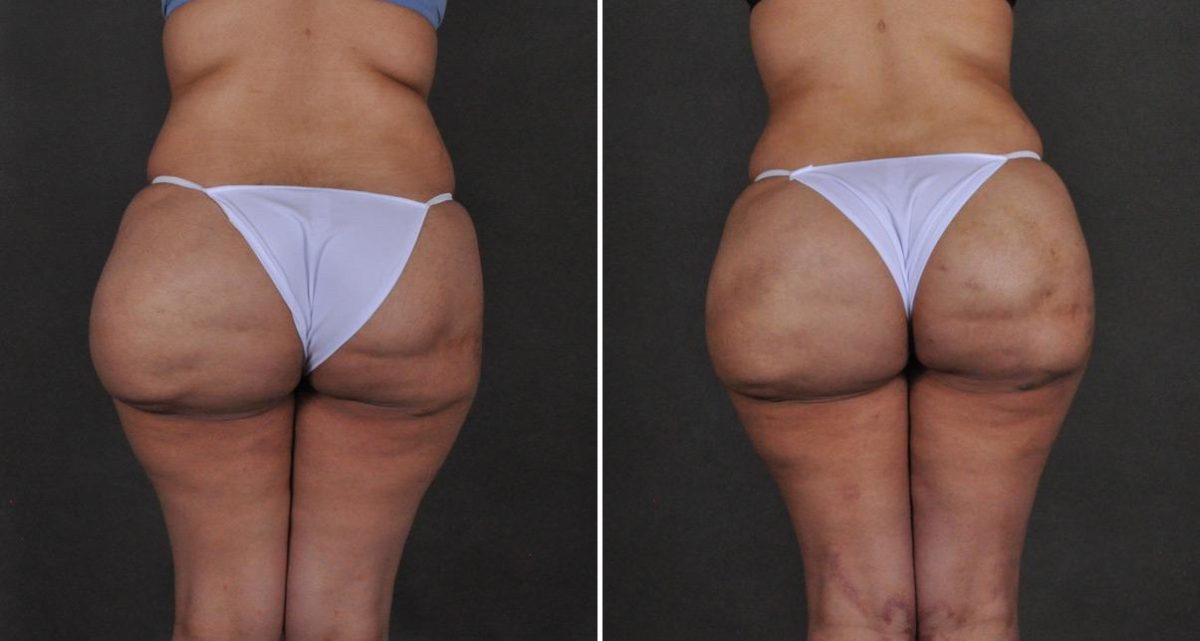 Brazilian Butt Lift Before and After Photos in Omaha, NE, Case 10228