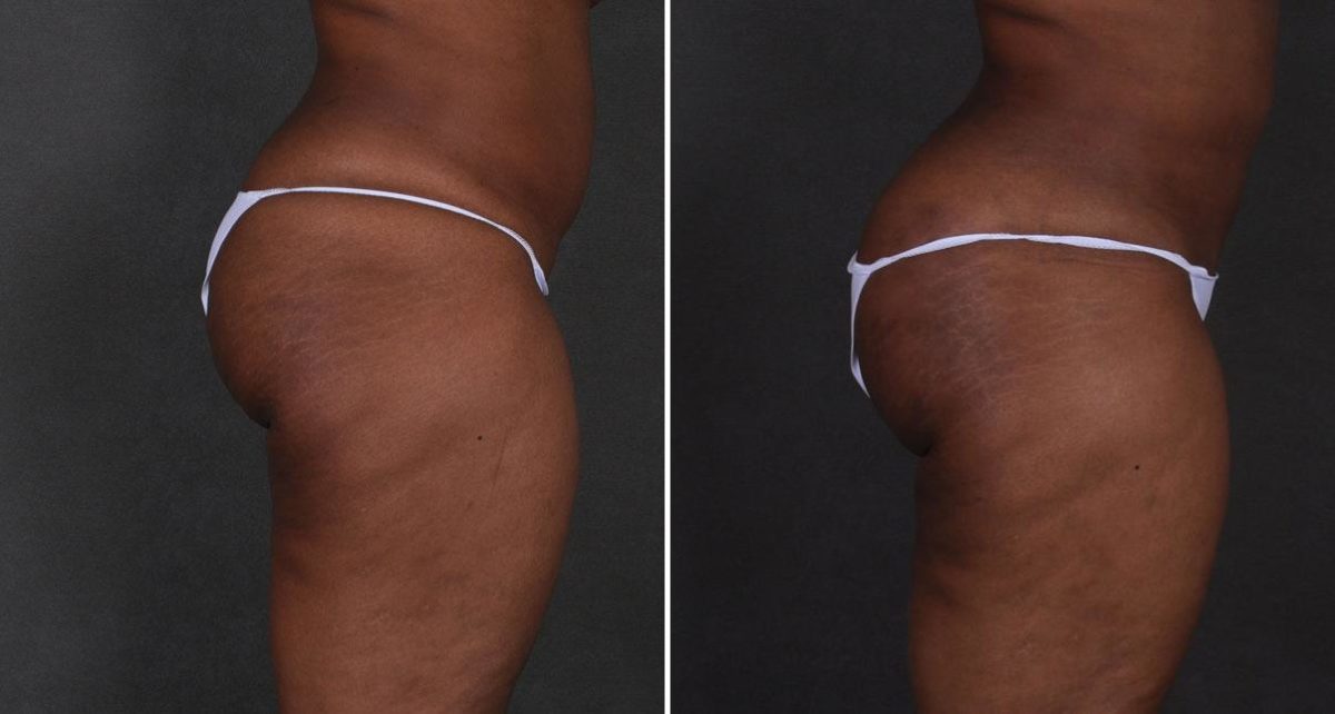 Brazilian Butt Lift Before and After Photos in Omaha, NE, Case 9194