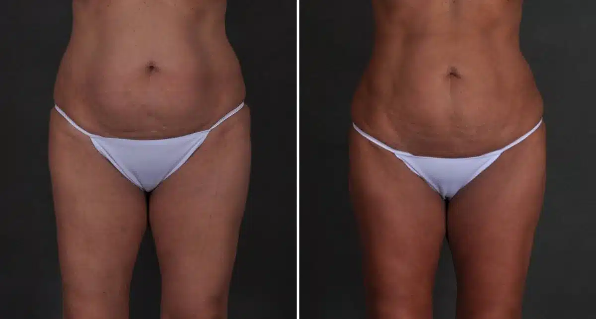 Brazilian Butt Lift Before and After Photos in Omaha, NE, Case 9339