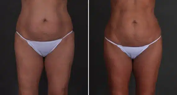 Brazilian Butt Lift Before and After Photos in Omaha, NE, Case 9339