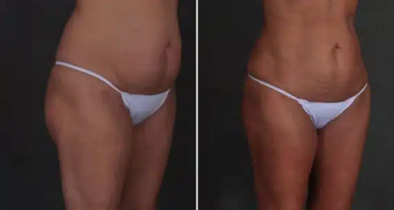 Brazilian Butt Lift Before and After Photos in Omaha, NE, Case 9339