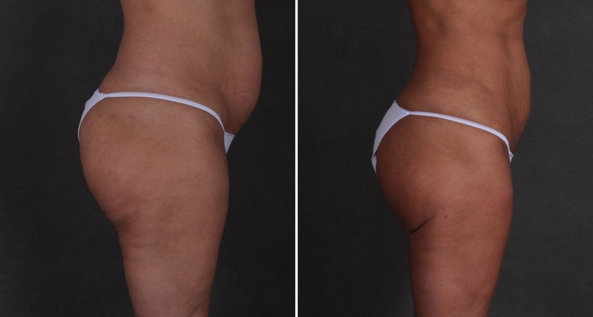 Brazilian Butt Lift Before and After Photos in Omaha, NE, Case 9339