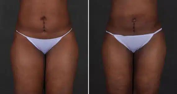 Brazilian Butt Lift Before and After Photos in Omaha, NE, Case 9194