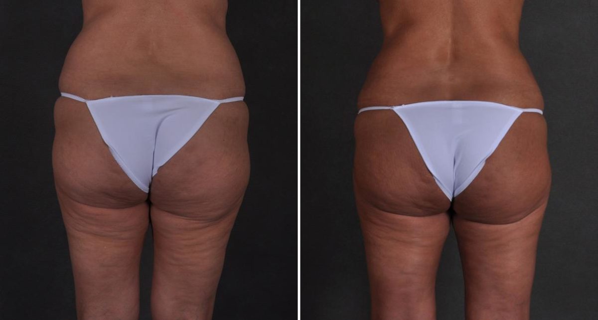 Brazilian Butt Lift Before and After Photos in Omaha, NE, Case 9339