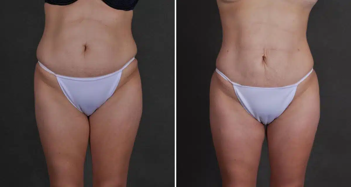 Brazilian Butt Lift Before and After Photos in Omaha, NE, Case 9774