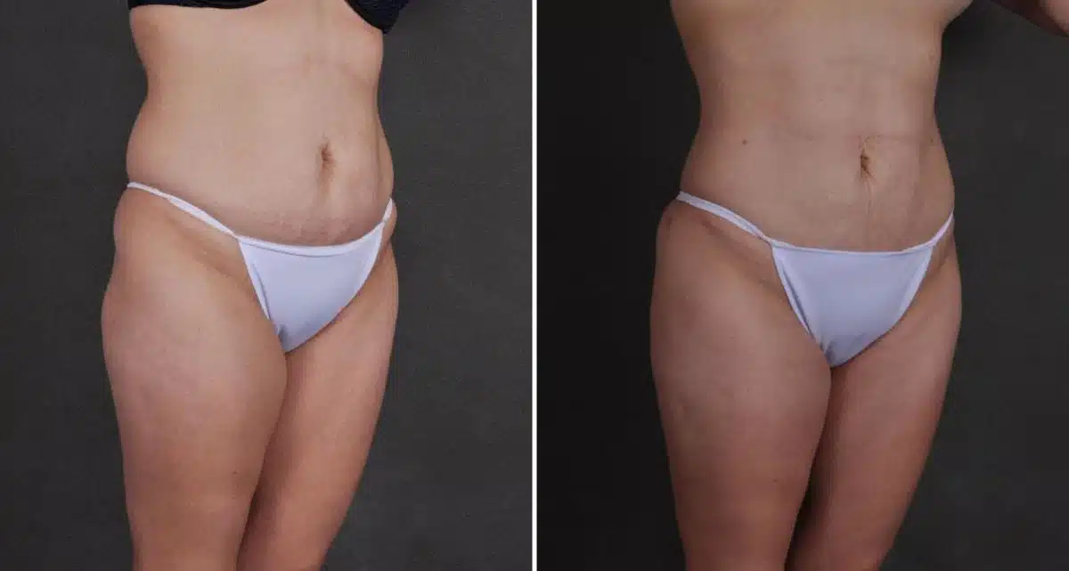 Brazilian Butt Lift Before and After Photos in Omaha, NE, Case 9774