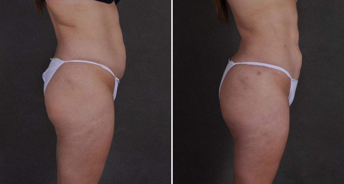 Brazilian Butt Lift Before and After Photos in Omaha, NE, Case 9774