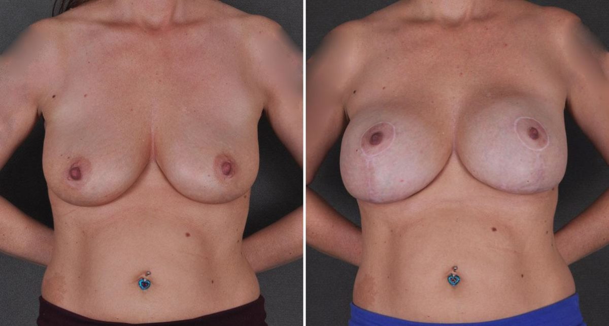 Breast Lift Before and After Photos in Omaha, NE, Case 9221