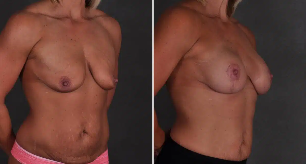 Breast Lift Before and After Photos in Omaha, NE, Case 9465