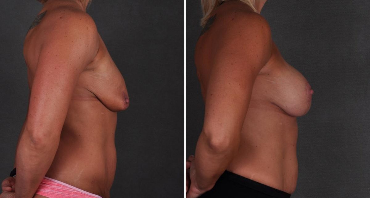 Breast Lift Before and After Photos in Omaha, NE, Case 9465