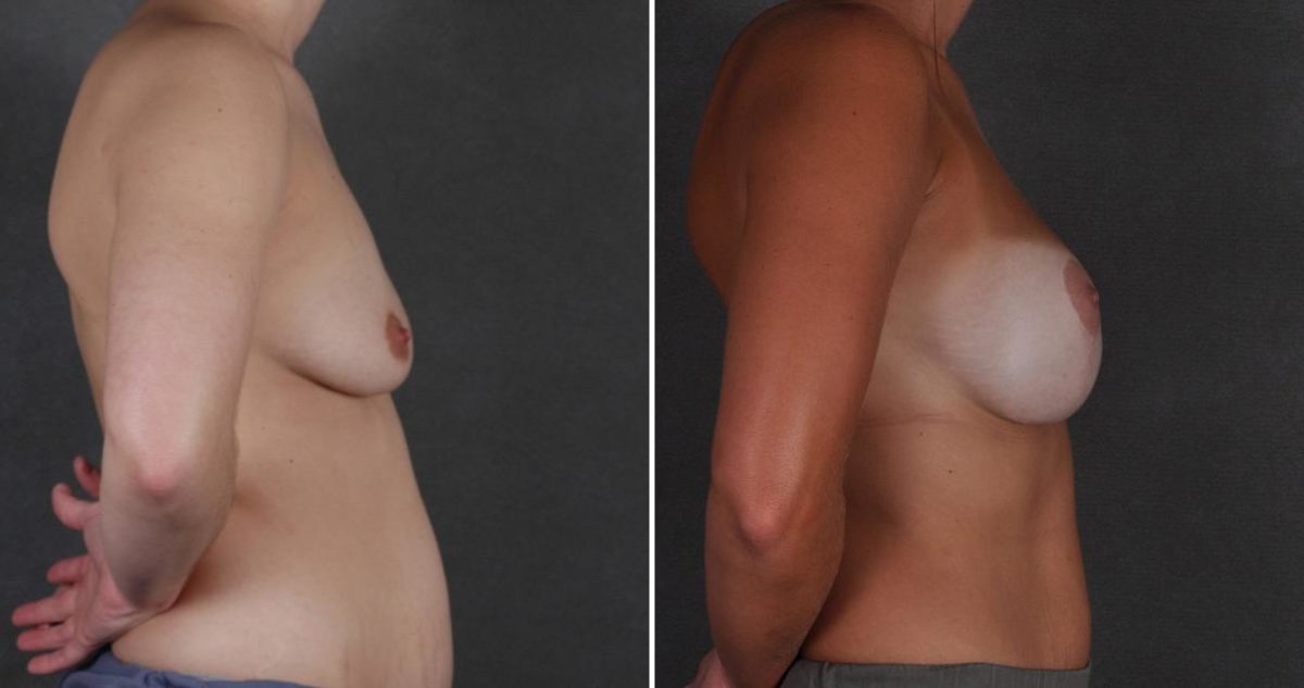 Breast Lift Before and After Photos in Omaha, NE, Case 9472