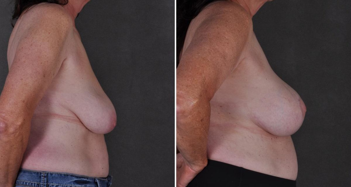 Breast Lift Before and After Photos in Omaha, NE, Case 9505