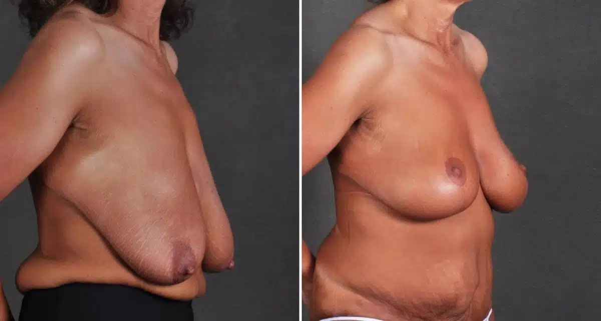 Breast Lift Before and After Photos in Omaha, NE, Case 9746