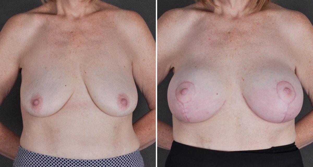 Breast Lift Before and After Photos in Omaha, NE, Case 9807