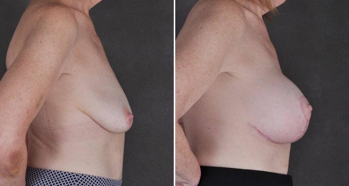 Breast Lift Before and After Photos in Omaha, NE, Case 9807