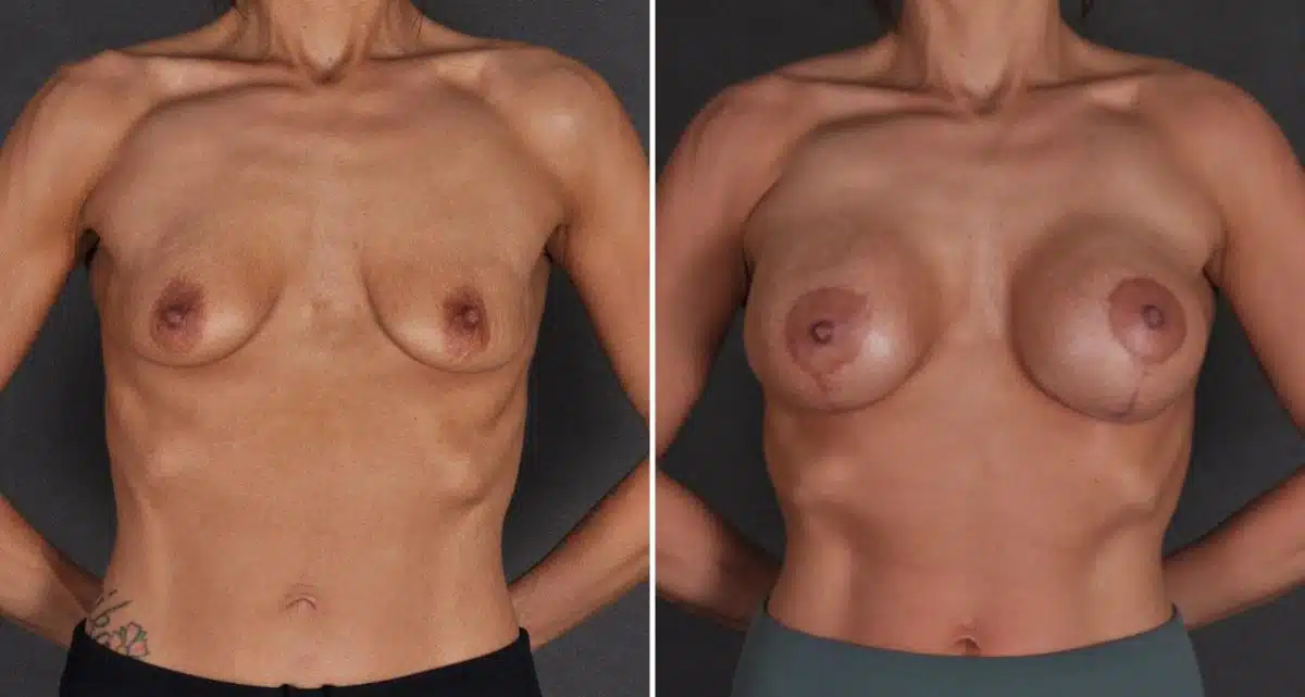 Breast Lift Before and After Photos in Omaha, NE, Case 9822