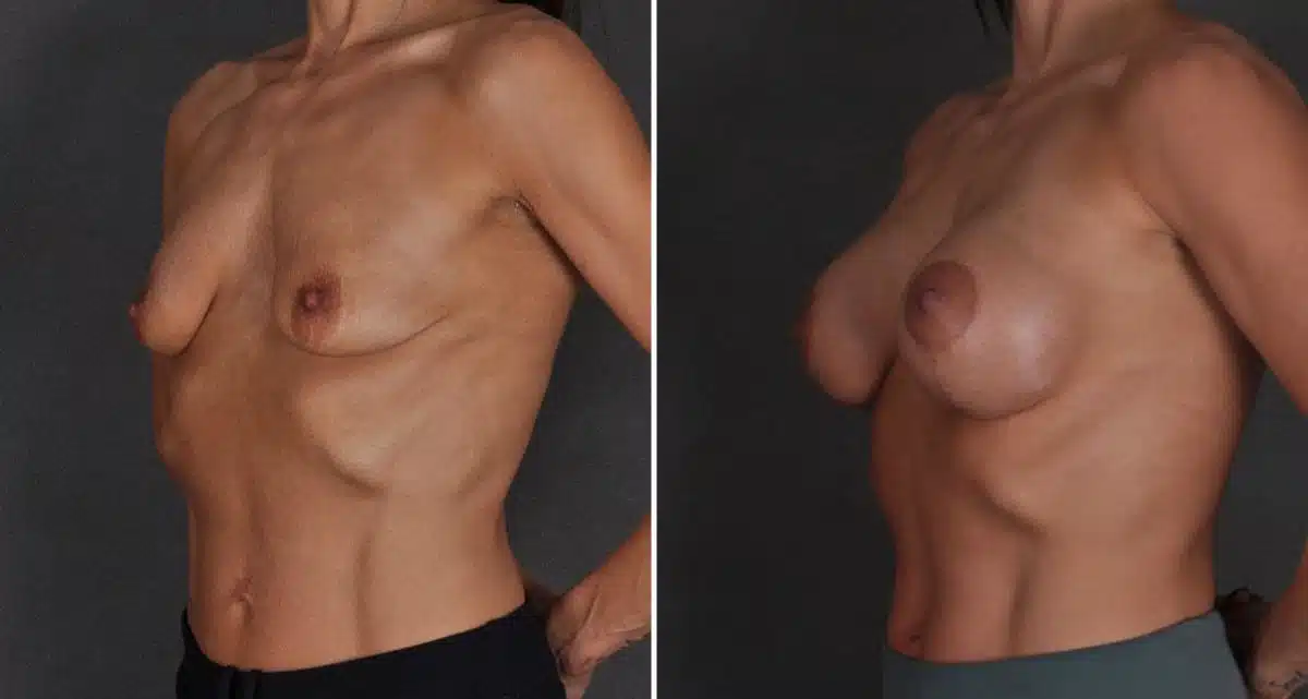 Breast Lift Before and After Photos in Omaha, NE, Case 9822