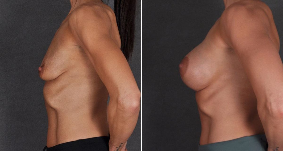 Breast Lift Before and After Photos in Omaha, NE, Case 9822