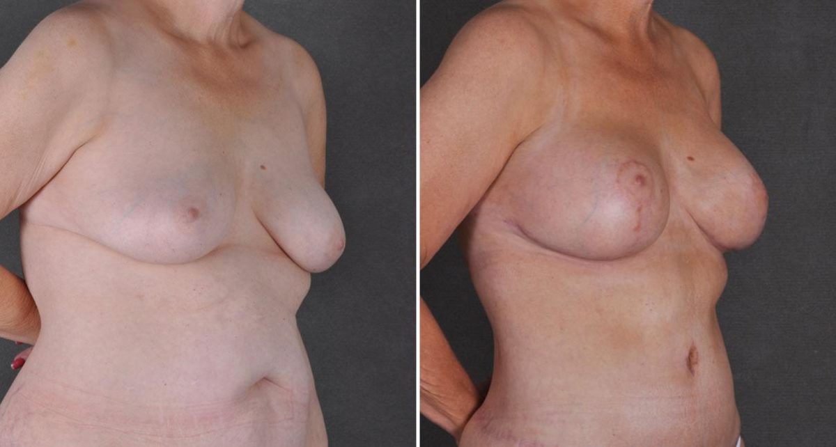 Breast Augmentation Before and After Photos in Omaha, NE, Case 9283