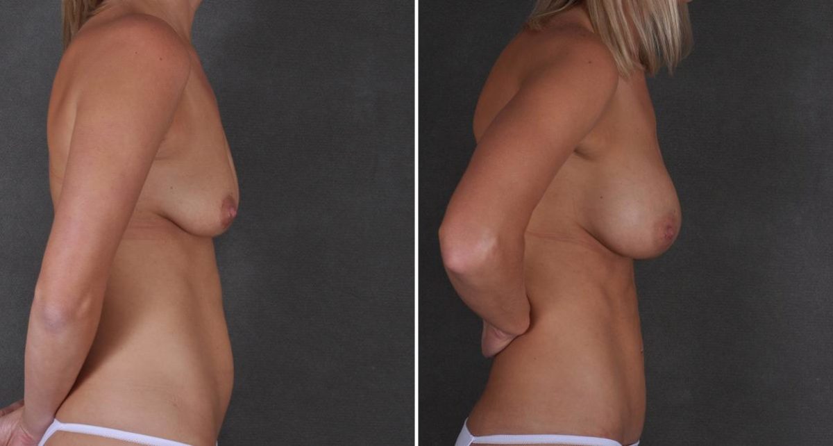 Breast Augmentation Before and After Photos in Omaha, NE, Case 9348