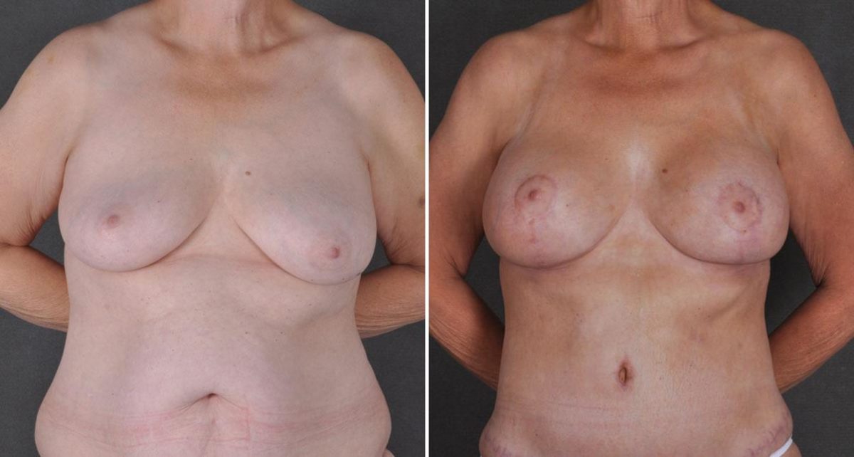 Breast Augmentation Before and After Photos in Omaha, NE, Case 9283